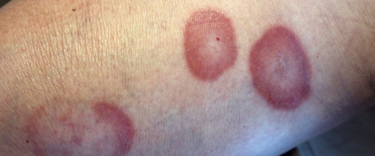 Granuloma Anular: Una Guía Completa para Comprender y Tratar esta Afección