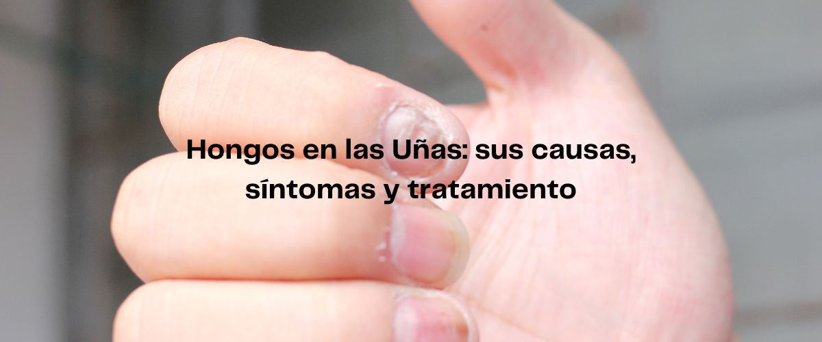 Hongos en las Uñas: Una guía completa sobre sus causas, síntomas y tratamiento