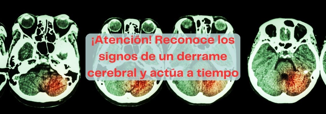 ¡Atención! Reconoce los signos de un derrame cerebral y actúa a tiempo