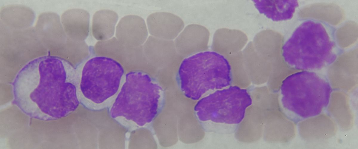 Leucemia: Comprendiendo la Enfermedad y sus Implicaciones