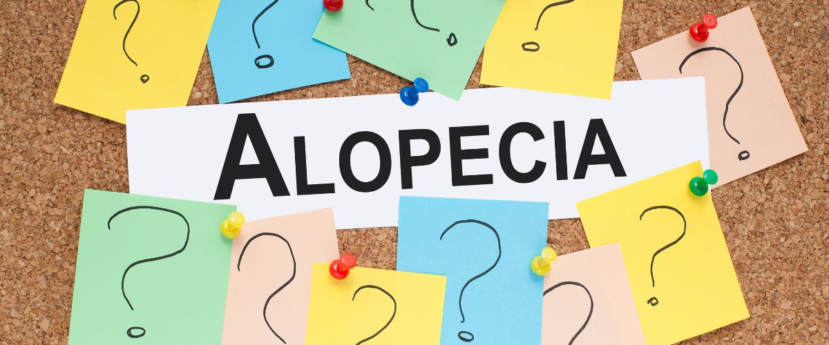 Descifrando la Alopecia: Todo Lo Que Debes Saber Sobre la Calvicie