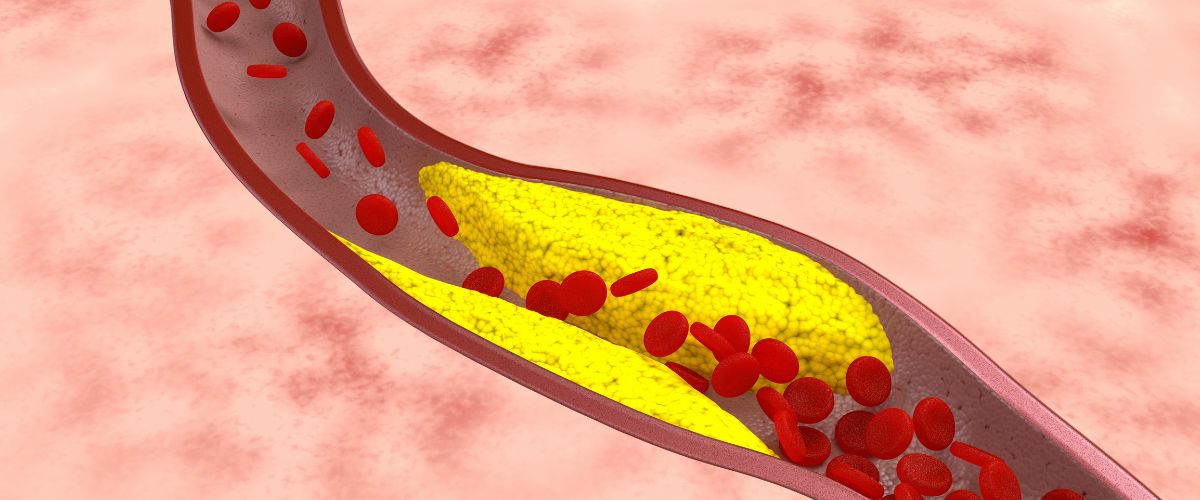 Aterosclerosis: Un Vistazo Detallado a la Enfermedad de las Arterias