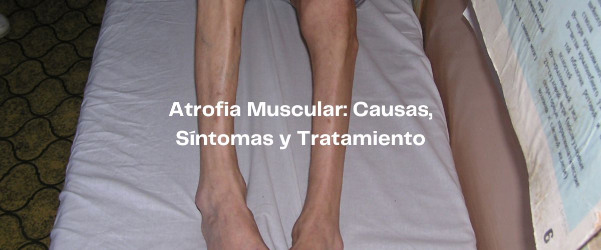 Navegando por la Atrofia Muscular: Causas, Síntomas y Tratamiento