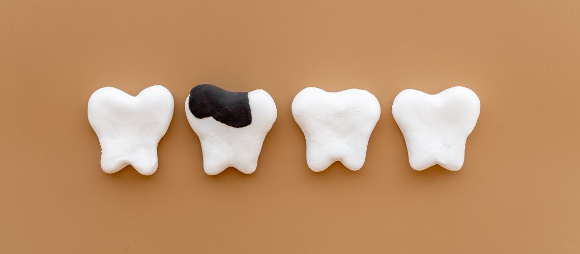 Caries Dentales: La Guía Definitiva para Prevenir y Tratar las Caries