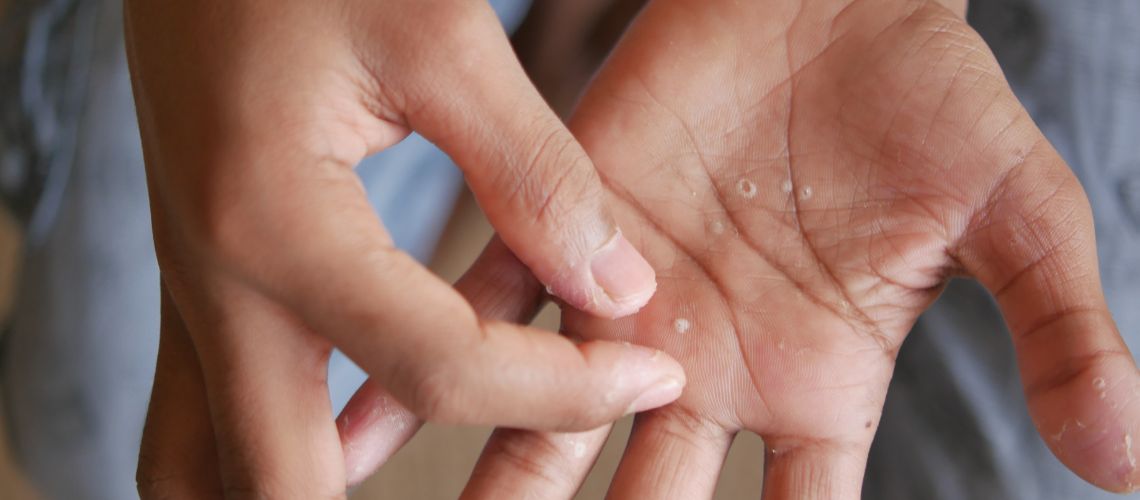 Dishidrosis en Casitodoonline