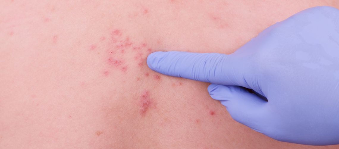 Guía Completa sobre el Herpes Zóster: Síntomas, Tratamiento y Prevención