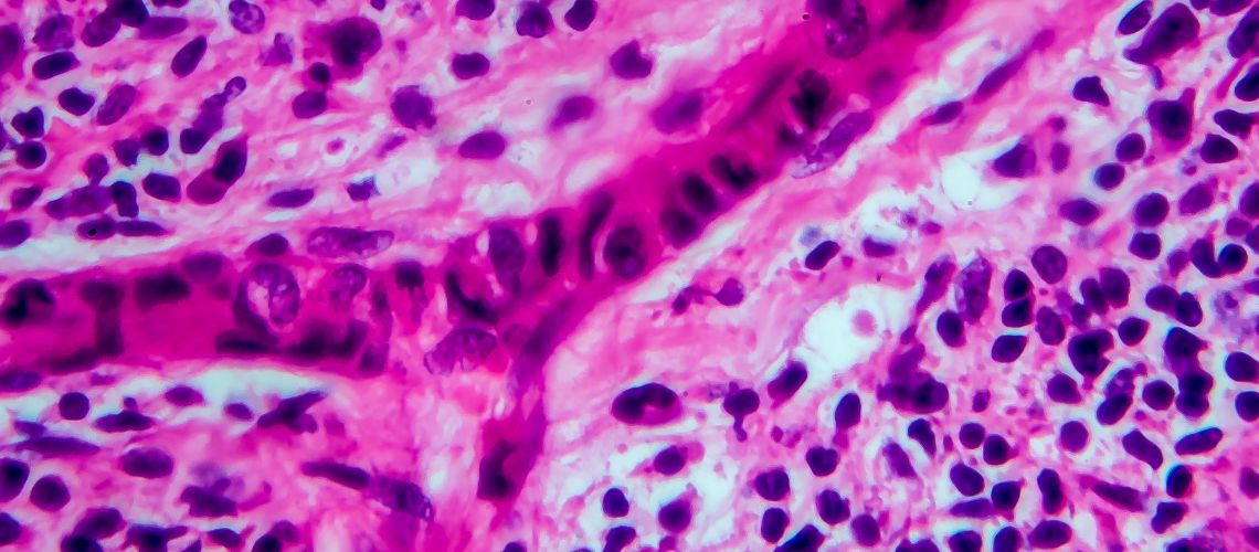 Linfoma de Hodgkin: Entendiendo la Enfermedad y su Tratamiento