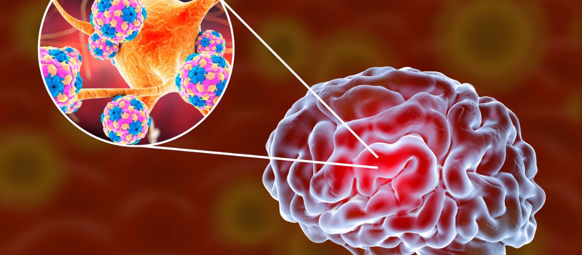 Meningitis Desvelada: Conozca los Síntomas, Causas y Prevención