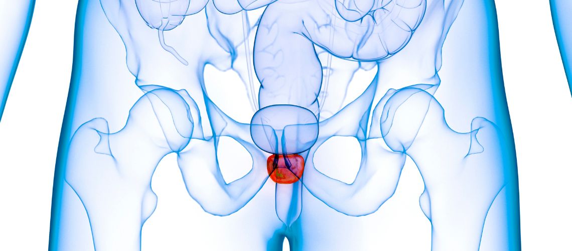 Soluciones Efectivas para la Próstata: Causas, Síntomas y Tratamientos
