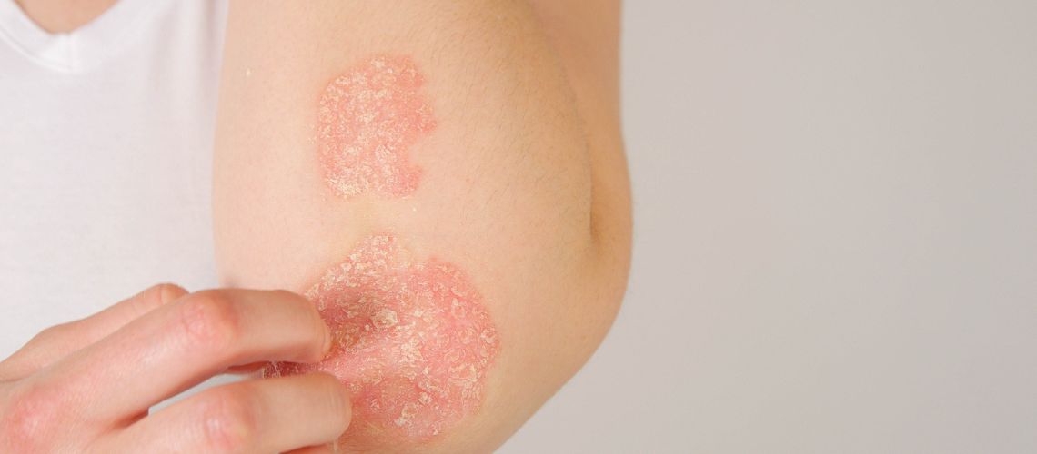 Cómo abordar la psoriasis de manera natural: Nuestra guía definitiva