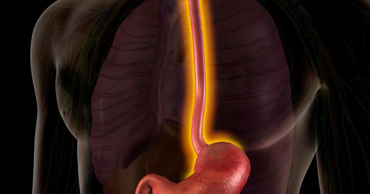 Várices Esofágicas: Una Amenaza Silenciosa y Mortal