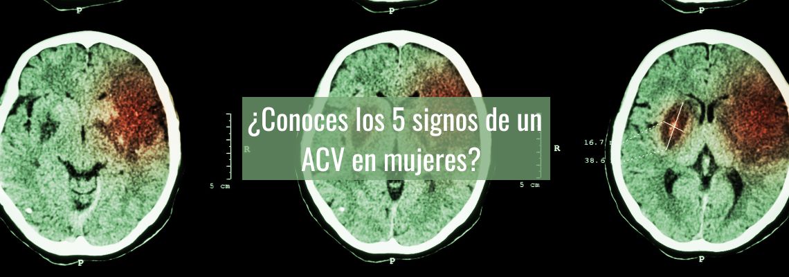 ¿Conoces los 5 signos de un ACV en mujeres? Descubre cómo identificarlos aquí